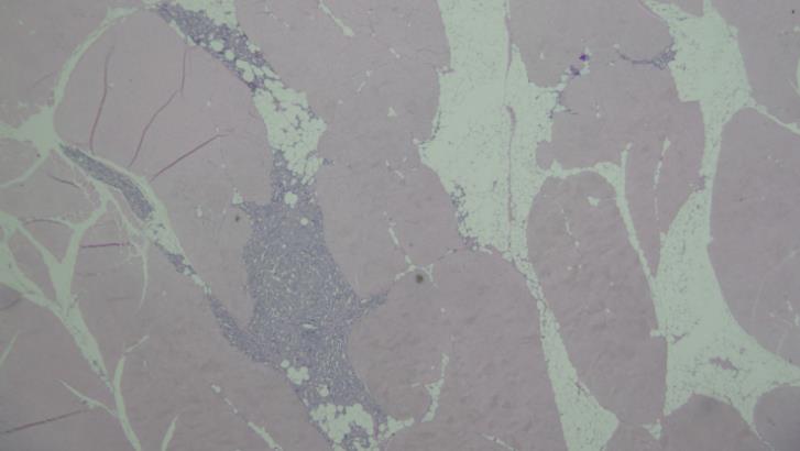 Figure 3: The histological results showed no interference between PLLA and fat after co-injection of PLLA with autologous fat. (H&E x 10). Zones E and F were designed to compare mono injection of HA and co-injection of HA with autologous fat.