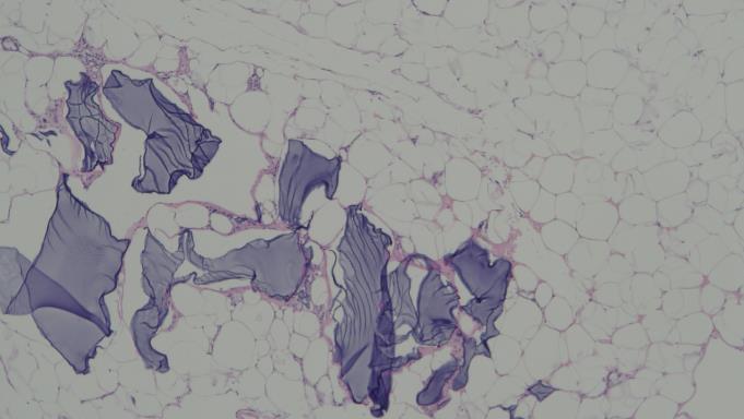 Figure 4: Mild fibrotic reactions occurred around autologous fat after co-injection of HA with autologous fat. (H&E x 40). Zone G: BTX was injected into the outside of the four corners of the zone G. A number of obvious fibrotic bands were found between Adipocytes (Figure 5), which was quite different from the previous histological sections.