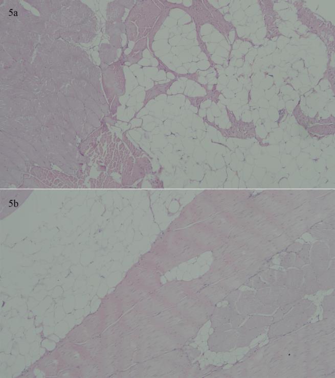 Figure 5: Obvious fibrotic reactions were found between grafted fat masses after botulinum toxin injection in each corner of zone G followed by the autologous fat injection in the center (a) H&E x 10; (b) H&E x 40.