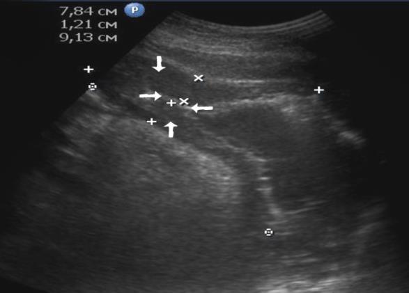 Figure 3: Echogram of the patient with the antrum adenocarcinoma with compensated pyloric stenosis. The thickness of the intact section of the stomach is 0,409cm, the anterior wall of the antrum is 0.94cm, the stenotic region is 0.69cm, and the peristalsis amplitude is 1.90cm. The arrows show the gastric cavity. Among patients with sub compensated pyloric stenosis, the thickness of the stomach wall was 19,2±3,8mm, the length was 42,8±4,3mm, the pyloric diameter was 4,5±1,2mm, the evacuation rate was 34±5cm/s, the volume of fasting contents 137±31ml, after 30 minutes after fluid intake - 294±31ml, after an hour - 265±27ml, the amplitude of peristalsis - 13±4mm, respectively.