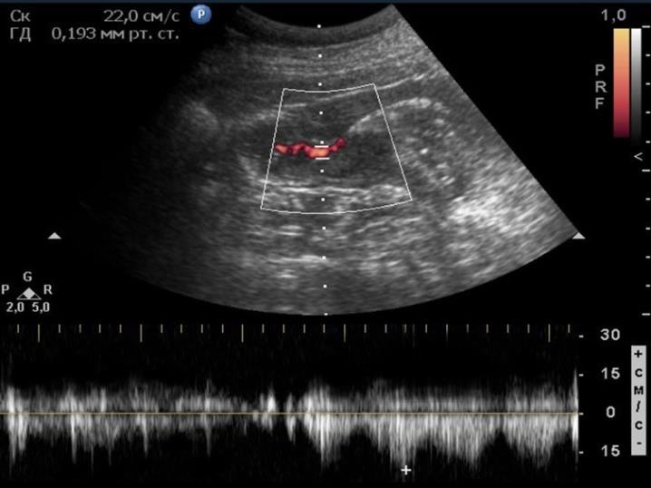 Figure 7: The same case. In the triplex mode, the flow of liquid through a stenosed pylorus is recorded at a speed of 22 cm/s.