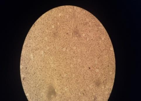 Figure 4: Cutaneous cryptococcosis mentally healing nodule after antifungal treatment. TCD4 lymphocyte typing was done in 33 (61%) patients with an average rate of 30 cells / mm3 [0-222 cells / mm3]. Viral load was performed in 25 (46.3%) patients with a mean 2.15 log10 copies / ml [undetectable - 7.51 log10 copies / ml] (Table 1).