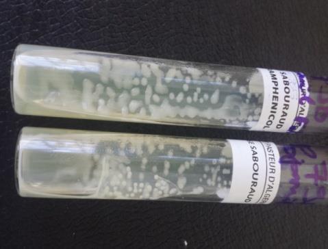 Figure 6: Cryptococcal cultured. As part of the extension assessment, cryptococcal antigenemia is contributive in (n = 34) 63%., two positive blood cultures. Direct urine examination and antigenuria are positive in (n = 2) 3.7%. Cutaneous involvement confirmed after biopsy in a single patient. Brain imaging (CT and / or magnetic resonance imaging) performed in 31 patients showed radiological abnormalities in 21 cases, of which eleven are micro-and macro-nodular hypodense images in the white matter in relation to probable cryptococomas, five in favor of cortico-cortical atrophy, and three are hydrocephalic and two are encephalitis. In 9 patients she returned normal (Figures 7 & 8).