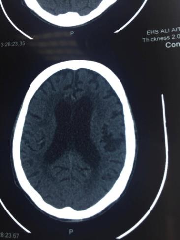 Figure 8: Hydrocephalus. The average duration of hospitalization is 30 ± 06 days [01 - 120 days]. In the induction phase, amphotericin B is prescribed as monotherapy at a dose of 0.7 mg / kg / d in (n = 47) 87%, fluconazole in (n = 4) 7.4%, the N Age sex SAD ART Opportunistic infection CD4 Tuberculose