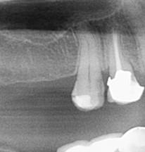 Figure 1: Pre-operative Radiograph. Patient was systemically healthy, non-smoker, without any deleterious habits. There was no evidence of any abnormality with respect to the maxillary sinus. Treatment protocol arrived at was placement of two implants with the dimensions of 3.4mm diameter and 11mm length with simultaneous sinus augmentation with allografts (DemboneTM; Los Angeles, CA). All procedures were fully explained to the patient and an informed consent was obtained.