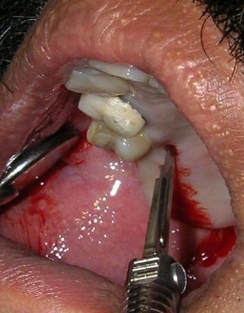 Figure 2: Surgical Exposure.