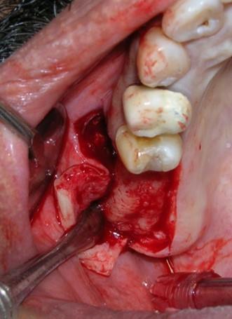 Figure 3: Exposure of Bony antral wall. A low speed high torque round bur with copious saline irrigation was used to outline a rectangular buccal window (Figure 4). The window was accordingly created and care was taken not to perforate the sinus membrane. Once the outline was completed, bone tap was used to separate the lateral sinus window wall. A delicate dissection, using blunt sinus elevators was performed to push the sinus membrane inwards and upwards. The membrane was released without any tension to provide an adequate compartment for placement of the implants with the allograft material (Figure 5). The cut window wall was pushed superiorly like a trap door so that the elevated sinus membrane rested on the bony wall. The distance between the alveolar crest and the inferior border of the window was measured to be 6 mm to facilitate simultaneous orientation of the implant.