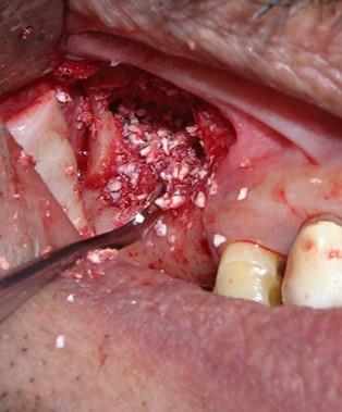 Figure 5: Placement of graft material. The implant site was marked using a surgical stent and the osteotomy was performed using sequential drills as recommended by the manufacturer. The implants were inserted and wrenched into the osteotomy site prepared on the alveolar crest by a hand-heldratchet. To achieve complete adaptation and stabilisation of the implant the created compartment was packed with allograft bone graft material (DemboneTM; Los Angeles, CA) and the created window covered by a bioabsorbable membrane (Periocol®-GTR, Eucare) (Figure 6). Primary closure of the mucoperiosteal flap was achieved using 3-0 silk sutures (Figure 7). Amoxicillin+Clavulanic acid 625 mg bid, Tinidazole 500 mg bid, Brufen+Paracetamoltid and 0.2% Chlorhexidine mouthwash were prescribed for 5 days during the postoperative period. Postoperative instructions were given. Sutures were removed on the 10th day, and the patient was scheduled for follow-up recall visits at 2 weeks and at 1, 2, 3 and 6 months. Healing was uneventful.