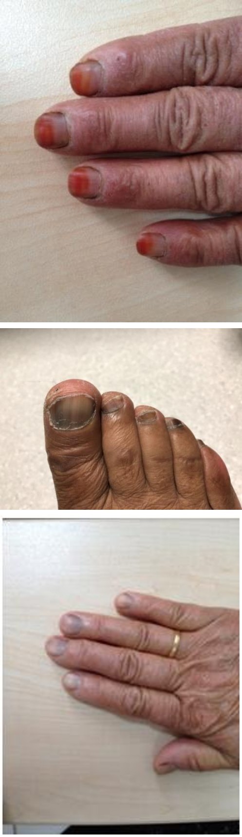 Figure 1: Diffuse pigmented bands on the proximal nail.