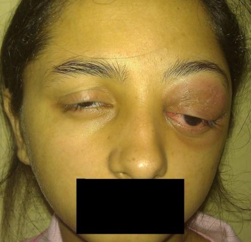 Figure 1: Clinical photograph of the patient showing left eyelid swelling, eryhthema, ptosis and left eye downward outward proptosis.