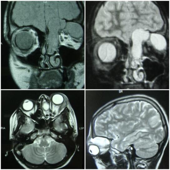 Figure 3: MRI Orbit suggestive of a bi-loculated lesion which is iso-hypointense on T1W images and hyperintense on T2W images with characteristic rim enhancement on post-contrast study. The mass is seen eroding the superomedial wall of the left orbit displacing the eyeball laterally and downwards, and extending to anterior cranial fossa.