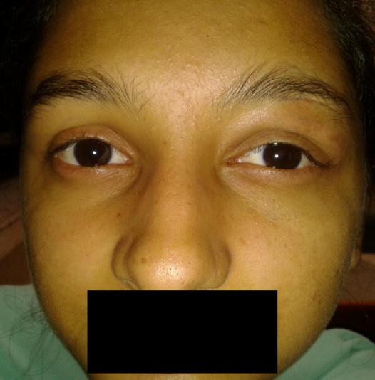 Figure 4: Subsidence of eyelid edema, proptosis and ptosis 2 weeks after surgery.