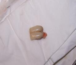 Figure 5: Preparation of lateral incisors and canines before removal of the bridge. After protecting the prepared vital teeth with varnish, the patient was referred to the department of oral surgery in order to extract simultaneously the tooth with the bridge (Figure 5). Sutures were performed to stop beading and to hasten and ease healing.
