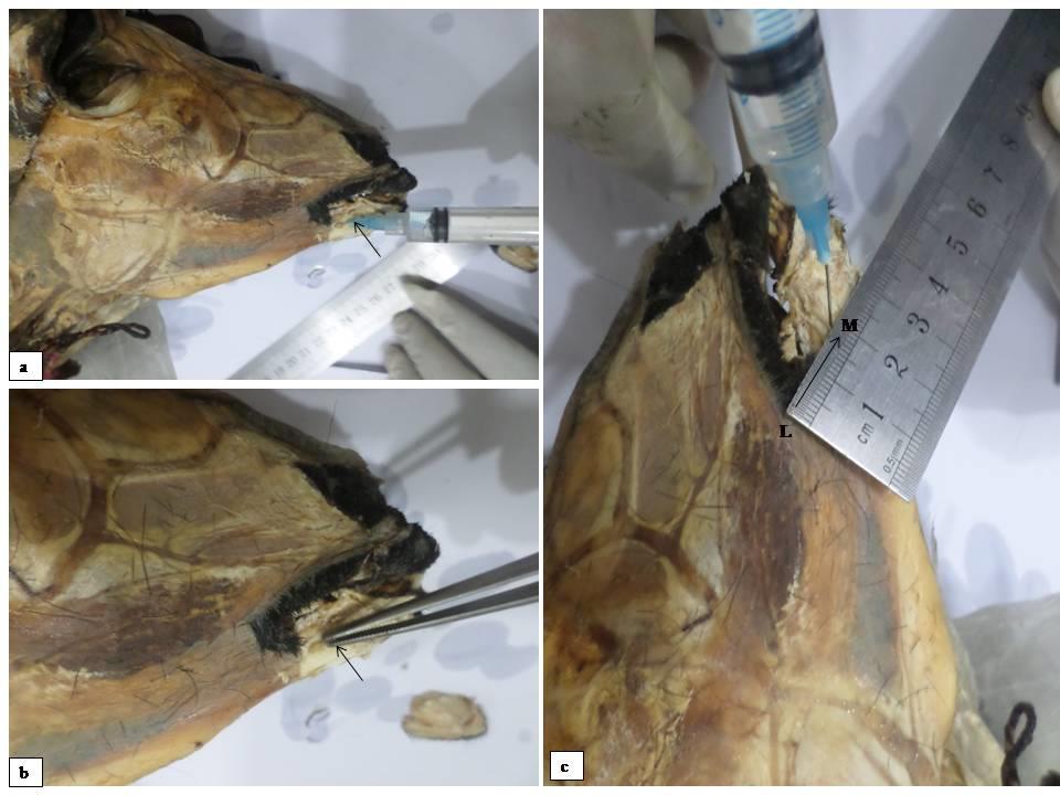 Figure 1: a. Mental foramen (needle insert), b. mental nerve (arrow) and c. distance between lip commissure to mental foramen (LM) (arrow).