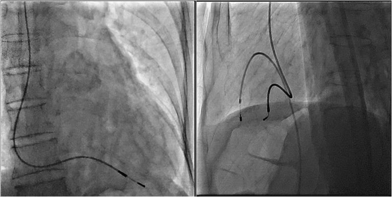 Figure 4: Fluoroscopy (AP & Lateral views) confirmed the pacing lead in right ventricle apex.
