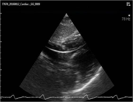 Figure 5: Echocardiogram (Sub costal view) showing pacing lead in RV apex.