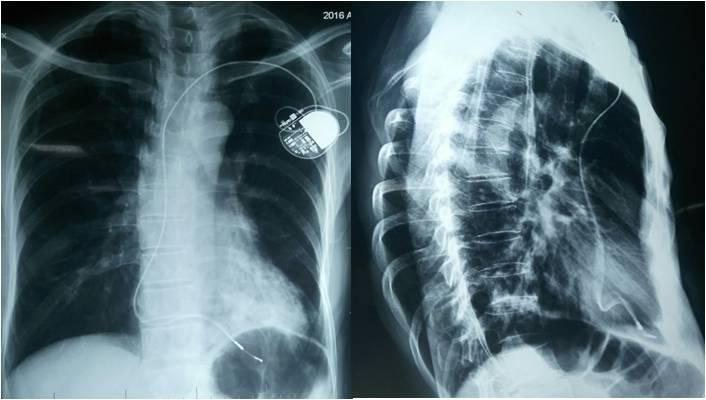 Figure 6: Chest X Ray (PA & Lateral views) showed pacing lead in RV apex.