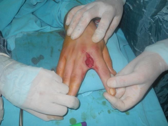 Figure 4: Defect area consisted in interdigital space after excision.