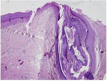 Figure 7: Histological image of the lesion (hematoxylin-eosin, ×4). The arrow points to the pilonidal sinus orifice. A sinus tract with a benign squamous epithelium is seen.