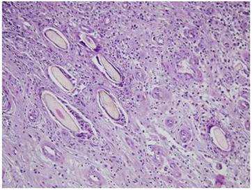 Figure 8: In chronic inflammatory granulation tissue, hair shaft (arrows) surrounded by foreign body type giant cells are seen. (H & amp; E).