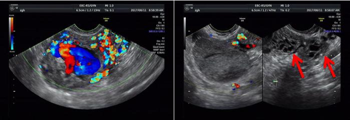 Figure 1: Color Doppler ultrasonography exhibited a heterogeneous echo at the left uterine cornea, which was projecting from muscular layer to serous layer.