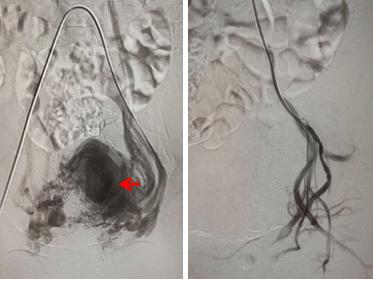 Figure 4: MRA showed malformed vessels on the left half of the uterus (the left, red arrow). After embolization, the blood flow was blocked (the right).