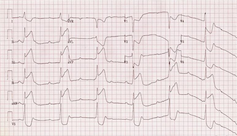 Figure 1: ECG showing Inferior wall ST-segment elevation myocardial infarction (ST elevation in lead II,III and a VF) with atrio-ventricular dissociation suggestive of complete heart block.