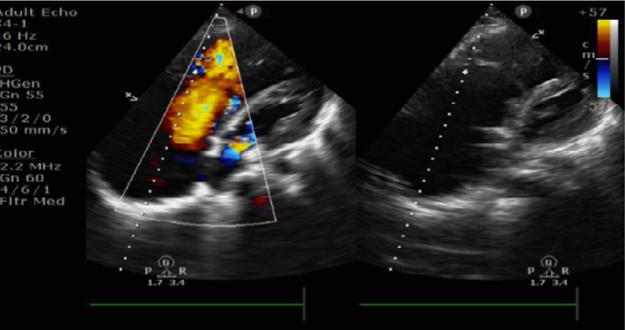 Figure 2: Echocardiogram (Apical four chamber view) showing displaced septal leaflet into the right ventricle and tricuspid regurgitation jet originating at junction of functional right ventricle and the atrialized right ventricle.