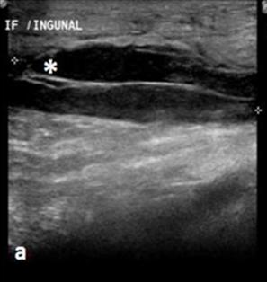 Figure 3: Microscopic pathology of a 25-year-old female with abdominal actinomycosis.