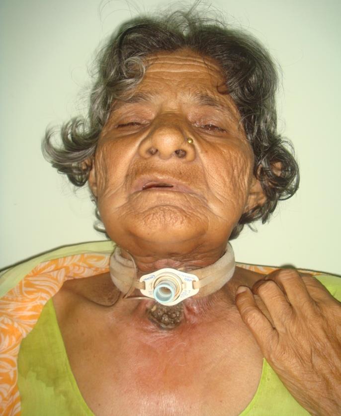 Figure 1: Photograph showing maggots below tracheostomy stoma.