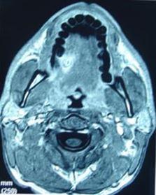 Figure 2: More posterior imagine of the lesion.