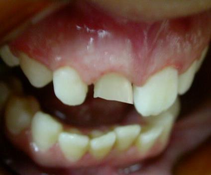 Figure 1: The right central incisor was fractured and stained. Clinical examination revealed that this tooth had short clinical crown and endodontically treated (the periapical X-ray is unfortunately not given in this article). It was asymptomatic. , and was planned for one piece post crown. Before treatment is rendered, all facts and ﬁndings related to the patient’s disease state should be recorded. First, the patient was recommended to take up initial periodontal preparation and to intensify oral hygiene before starting the rehabilitation process [4,5]. Tooth preparation for endodontically treated teeth can be considered a three-stage operation: removal of the root canal ﬁlling material to the appropriate depth, enlargement of the canal and preparation of the coronal tooth structure. The aim of post space preparation is to determine the axis of seating of the metal ceramic post crown .the common used methods to remove gutta-percha are the use of a warmed endodontic plugger or using a rotary instrument, sometimes in conjunction with chemical agents. The post length is equal to two –third the length of the root and at least equal to the height of the anatomic crown, and an amount of 5mm of apical gutta percha should be left. Nevertheless, on short teeth an absolute minimum of 3mm of apical ﬁll is needed. Regarding post diameter, it should not exceed one third of the cross sectional root diameter; when a post is to be used, further reduction is needed to accommodate a complete crown and to remove undercuts from the chamber and internal walls. If more than 2mm of coronal tooth structure remains, the post design probably has a limited role in the fracture resistance of the restored tooth. For post space preparation, gutta percha was removed from the pulp chamber using a thin straight fissure, then a Peeso Reamers (sizes 1 to3), or a twist drill can be used and this is due t to the circular cross-section of the central incisor root [6]. The prepared space was cleaned with mouth wash. The coronal tooth structure was prepared with rotary instruments to provide a sufficient clearance. Every effort should be made to save as much of the coronal tooth structure as possible, because this helps reduce stress concentrations at the gingival margin Care must be taken so that part of the remaining coronal tissue is prepared perpendicular to the post and facial structure of the tooth is adequately reduced for good esthetics [7]. The remaining walls often are thin and weakened because tooth structure has been removed internally and externally, but a width of 1mm is mandatory to avoid jeopardizing the resistance form and an antirotation groove should be placed in the facial preparared wall (Figure 2).
