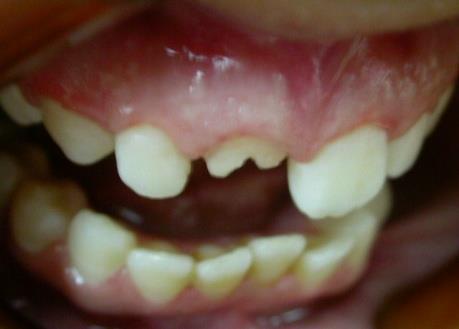 Figure 2: Extracoronal preparation parallele to the long axis of prepared canal. Note the antirotation groove placed in the facial preparared wall. An impression of the post space was taken with the tooth preparation using vinyl polysiloxane impression material where light body was injected into the sulcus by a syringe after removing the displacemet cord, and inside the prepared post space by a lentulo and a reinforcement wire, as metal post, was inserted to support the material. Additional rubber base materials were then injected around the preparation and the tray filled with heavy body impression material and seated on the light body. The framework was casted in a Nickel - chromium alloy (Figure 3) following standard laboratory procedures [8]. It was finished and polished, returned to the master cast, and tried intraorally to confirm fit, insertion retention , marginal integrity, and mostly the space left for cosmetic ceramic (Figure 4) [9].