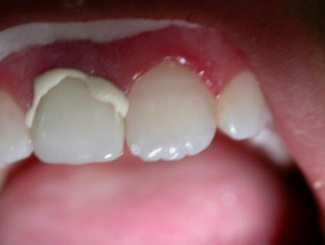 Figure 5: Cementation of the one piece post-crowns using adhesive cement.