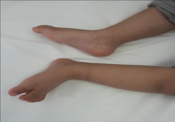 Figure 2: (photo. Taken with parents permission): complete recovery of the edema after two weeks.