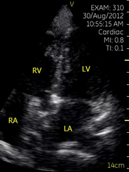 Figure 10: Large amount of pericardial effusion and chronic exudative pericarditis. Parasternal short-axis view of left ventricle at apical level showed a large amount of pericardial effusion and honeycomb-like structure in pericardium. PE= pericardial effusion, LV= left ventricle, RV= right ventricle.