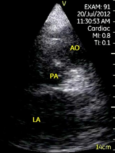 Figure 8: Carpentier device after transcatheter interatrial septal defect closure. Apical four-chamber view showed a device on the interatrial septum between right and left atrium. LV= left ventricle, LA= left atrium, RV= right ventricle, RA= right atrium.