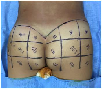 Figure 1: BACVA technique: 9 quadrant pattern, each buttock is divided into thirds in a vertical and horizontal direction, resembling a wind rose with the 4 primary and 4 minor resulting zones. General anesthesia was administered and skin was prepped with povidone-iodine solution. The genital and anal areas were isolated with povidone-soaked pads. All patients received a preoperative dose of cefalotin (unless allergic) plus clindamycin. After infiltrating normal saline wetting solution with epinephrine (1:500,000) and no additional lidocaine and waiting 15 minutes, traditional lipoaspiration was done in previously marked areas. The initial lipoplasty/fat grafting procedure was performed either with a 60mL syringe or a lipoaspirator set on low power. The lipoaspirate was left to settle by gravity and gentle filtration, avoiding any traumatic processing. Formerly we transferred the lipografts with the same 60mL syringes and 3mm cannulas at the beginning, but we modified our technique incorporating 10 mL syringes and using 2mm atraumatic cannulas.Lipografts were delivered in a controlled fashion with small 2-3 mm retrograde movements, distributing themin different planes from deep to superficial and from caudal to cephalic subcutaneous tissues, forming a three- dimensional grid. This procedure was performed on each buttock as needed until desired shape and symmetry were achieved (see Video, Supplemental Digital Content 2, which demonstrates the BACVA technique). We systematically applied a firm massaging motion to each buttock when needed in order to homogenize any remaining irregularities. After lipografting, when extensive liposuction of the back was performed, we consistently left close suction drains above the buttock area. This strategy aimed to isolate the lipografts from the back’s drainage, in order to reduce the possibility of buttocks´ infection or collection. Drains were removed once serous drainage was reported less than 30cc in 24 hours. Incisions were closed with 4-0 non-absorbable sutures. Immediate compression garments were indicated in every patient over lipoaspirated areas. The buttocks remain edgarment free, reducing the possibility of compression ischemia. All patients were hospitalized for 24 hours, and had apostoperative full blood count. Oral antibiotic (a first generation cephalosporin + clindamycin) and analgesic medications (non-narcotic) were prescribed for a week. Immediate movilization was encouraged. Compression garnments were indicated for 6 weeks.