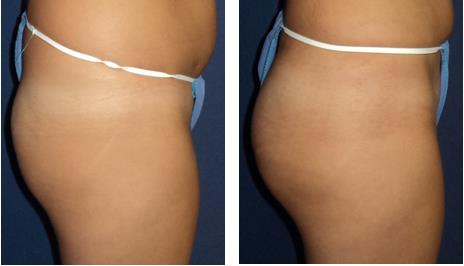 Figure 2: Pre and postoperative images. Female patient with 300cc of lipoinjection with BACVA.