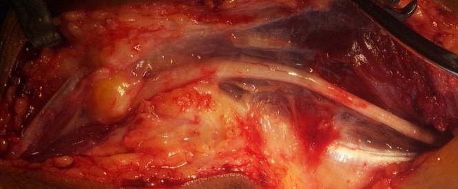 Figure 1: Image showing Ganglion arising from ulnohumeral joint.