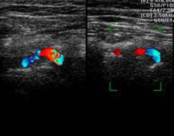Figure 3: Color Doppler view of the vertebral artery at the level of C3-C4 and C4-C5.