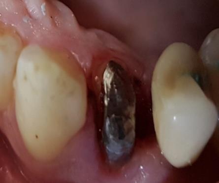 Figure 12: Post and core pattern removed from the abutment tooth.