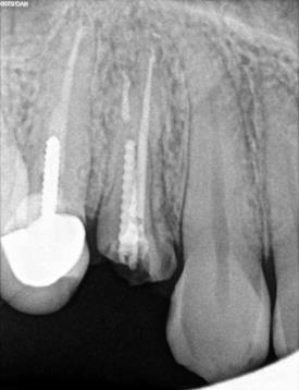 Figure 3: Maxillary right first Premolar was endodontic ally treated tooth, with a remaining screw post.