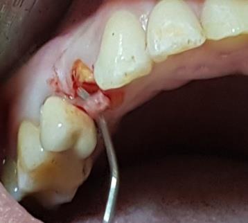 Figure 4: Surgical crown lengthening. The interim restoration was performed by two techniques: by Using the existing prosthesis as a provisional restoration which was lined with autopolymerising resin (Figure 5) or a preformed polycarbonate crown which needed addition by the lining procedure and some modiﬁcation (internal relief, axial recontouring, occlusal adjustment) (Figure 6) and each technique needed a metal post to improve retention which was inserted in the remaining post space already under taken for the old screw post. Thus the interim crown was a temporary post crown (Figure 7) which provides occlusal function, protection of the tooth structure ,ability to be cleaned, and restores function and esthetics during healing [11]. The provisional crown was cemented in place using non-eugenol temporary cement.