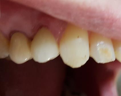 Figure 5: Using the existing prosthesis as a provisional.