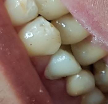 Figure 6: A preformed restoration polycarbonate crown as Interim crown.