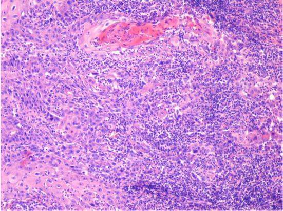 Figure 3: Microscopic aspects in a moderately differentiated lip carcinoma with squamous cells stroma infiltrated with immune cells (Hematoxylin- Eosin staining) [3].