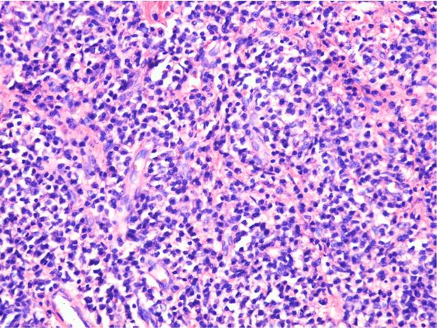 Figure 4: Poorly differentiated carcinoma of anterior pillar of amygdale. Stroma rich in inflammatory cells and angiogenesis vessels (Hematoxylin-Eosin staining) [3] Poorly differentiated squamous cell carcinomas were designed as cellula cords, islands or epithelioid-like cells of various shapes and sizes, with a different design from the normal epithelium. The various aspects of cancer cells means the malignant tumors are heterogeneous entities, multicellular, containing multiple cell lines whose interactions with each other and with the extracellular matrix through paracrine secreted soluble molecules are dynamic and promote cell proliferation, movement and differentiation of neoplasia (Figure 4). Tumoral stroma results from the conversion of covering epithelium corium into stroma with particular features, as an adaption reaction to the tumoral invasion. Due to its vascular density, it has nutritional and supportive role for tumoral cells.
