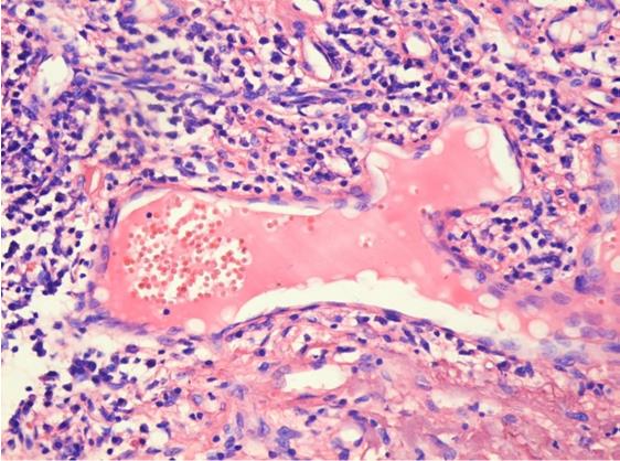 Figure 6: Well differentiated squamous cell lip carcinoma Tumoral stroma with young tissue, associated with vascular congestion (Hematoxylin- Eosin staining) [3].
