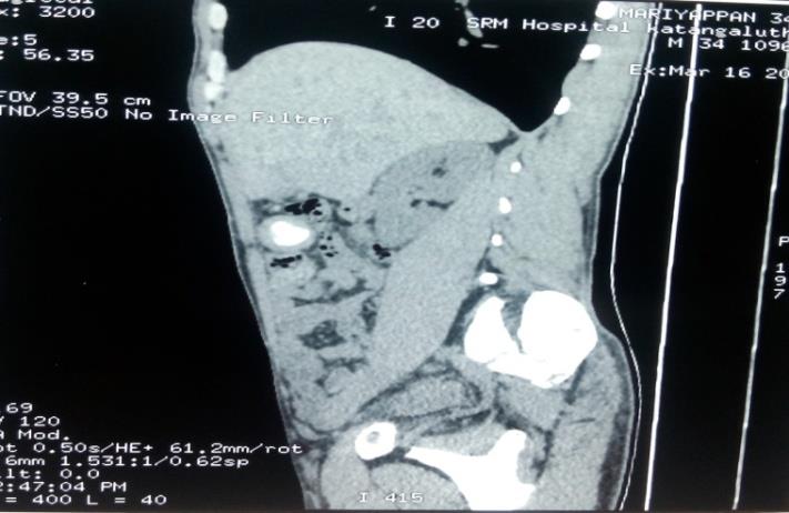 Figure 2: Sagittal view of abdomen of computed tomography showed lesion on hepatic flexure with laminated calcification.